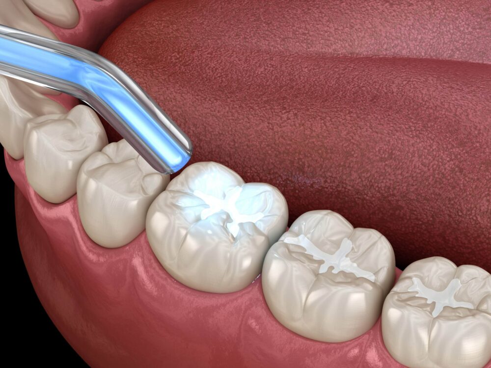 Illustration of a dental procedure where a curing light is being used to harden a white filling in a molar tooth inside the lower jaw, with the tongue visible in the background—similar to how dental sealants Wayzata are applied for added protection against decay.