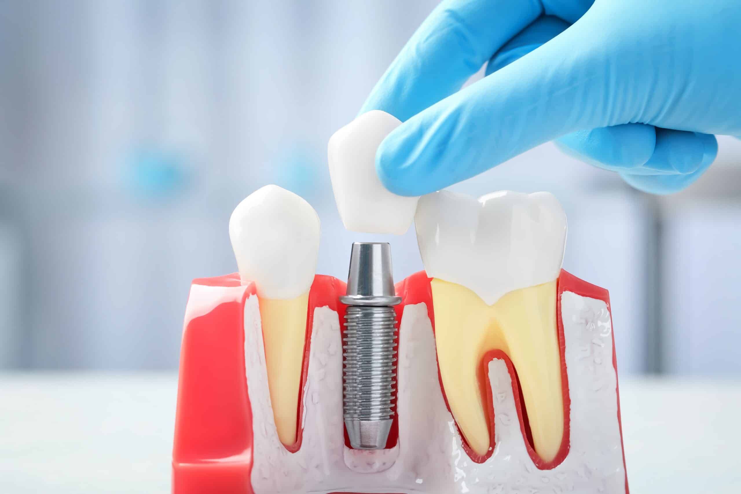 A gloved hand places a dental crown on an implant model between two tooth models, illustrating a dental implant procedure as performed by dental implants Wayzata experts.