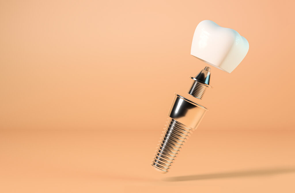 types of dental implants wayzata - image of a dental implant with the abutment and the crown.
