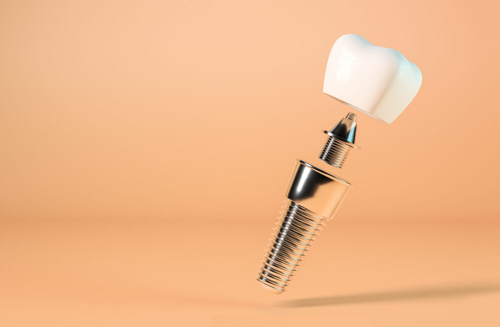 types of dental implants wayzata - image of a dental implant with the abutment and the crown.