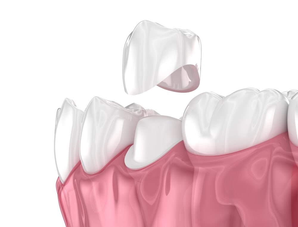 how much does a crown cost - image of a crown hovering over a tooth.