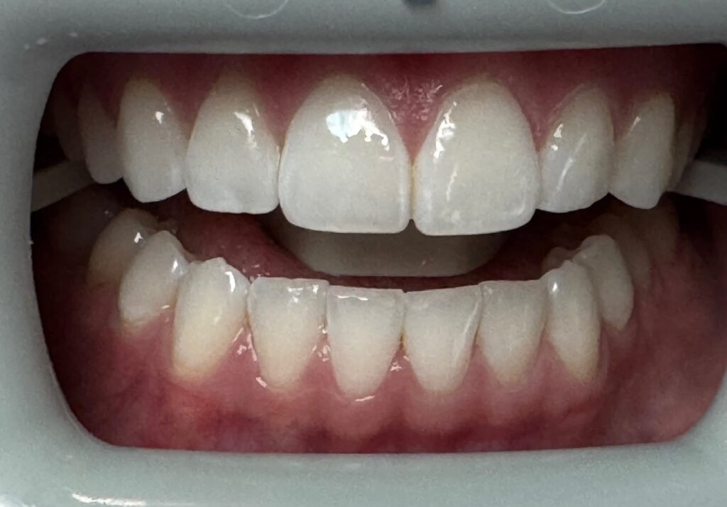 Close-up of a person’s mouth with a dental retractor, showcasing clean, white upper and lower teeth and healthy gums—an ideal result of Teeth Whitening Wayzata.