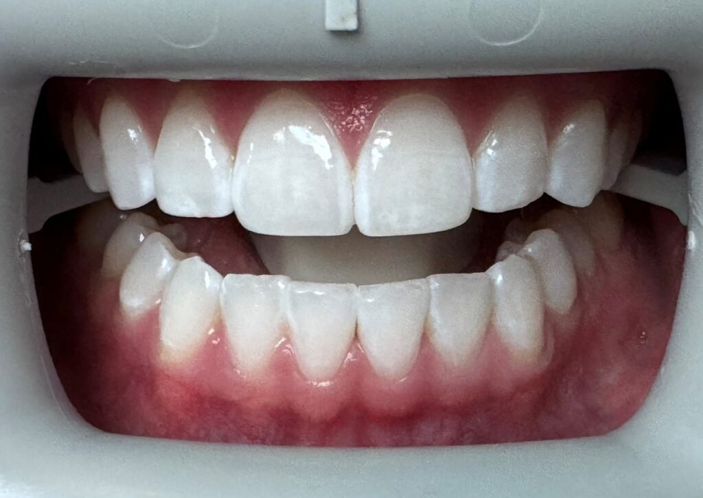 A close-up of a dental model showing upper and lower teeth, with the mouth slightly open, displaying healthy gums and straight white teeth—an ideal example of results from professional Teeth Whitening Wayzata.